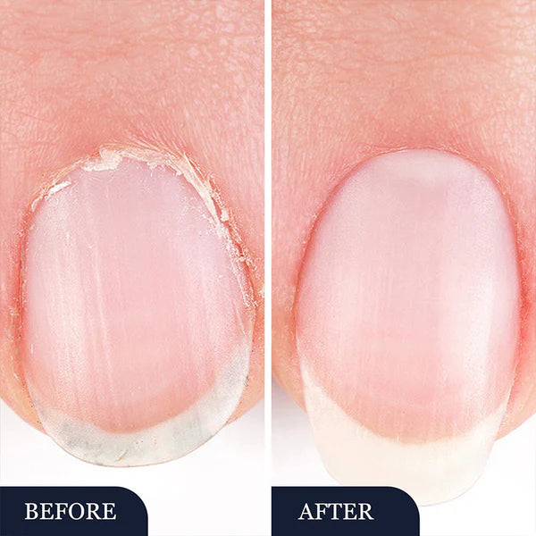 💅 ACQUISTA 1, OTTIENI 1 GRATIS! ✨ Penna per Trattamento di Micosi alle Unghie – Azione Rapida, Applicazione Precisa & Effetto Lenitivo 🦶