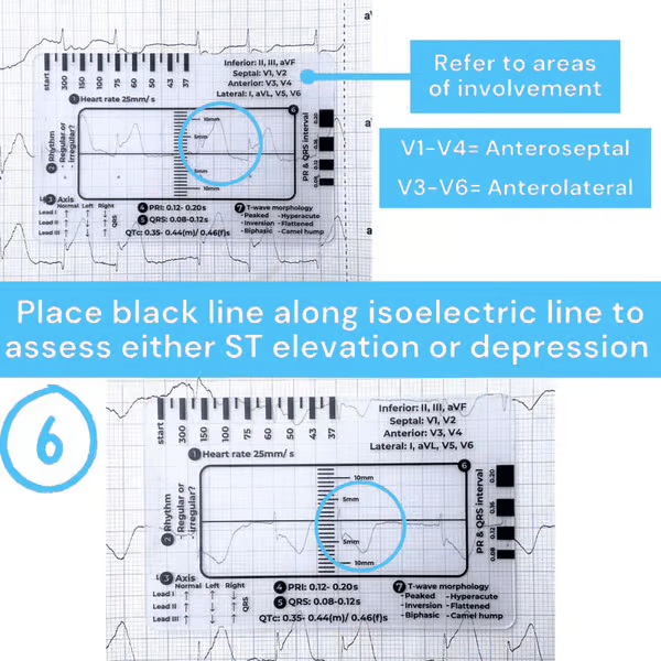 Righello ECG 7 fasi