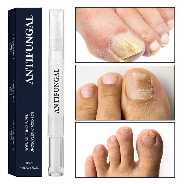 💅 ACQUISTA 1, OTTIENI 1 GRATIS! ✨ Penna per Trattamento di Micosi alle Unghie – Azione Rapida, Applicazione Precisa & Effetto Lenitivo 🦶