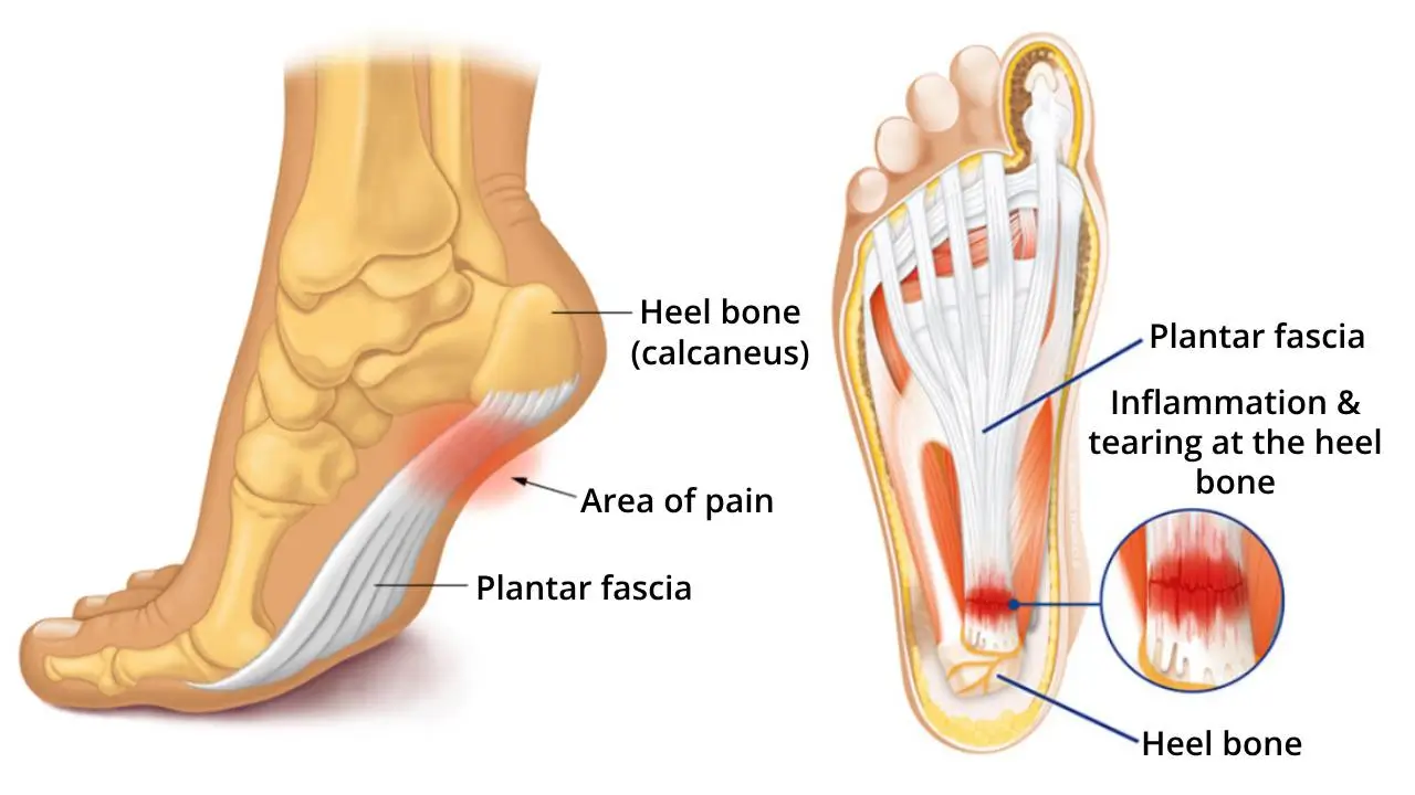 Soletta ortopedica rivoluzionaria