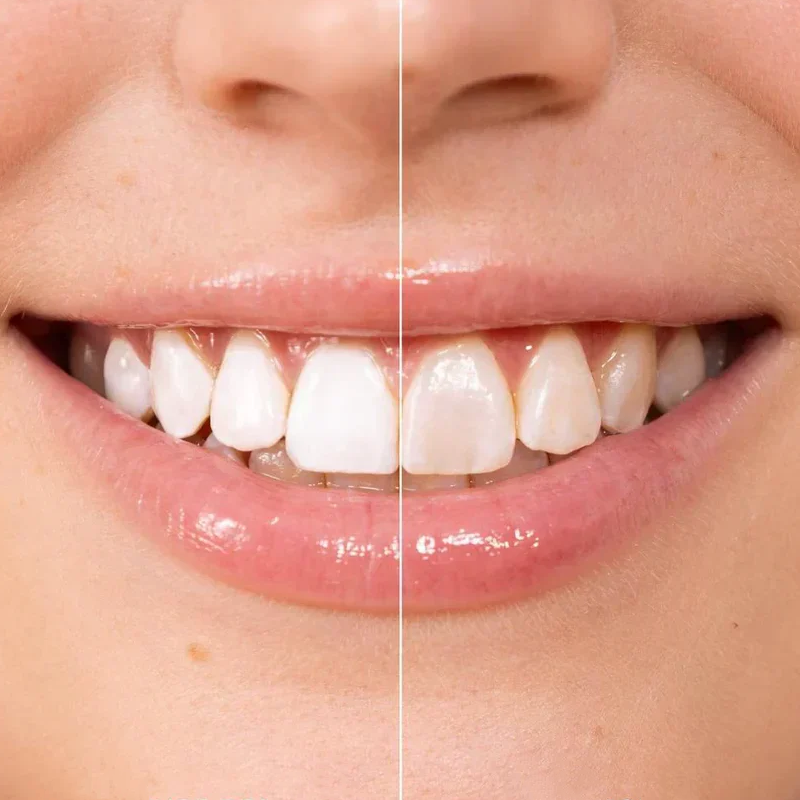 🦷Vernice sbiancante istantanea per denti da 5 ml – Effetto rapido, sicura per lo smalto e facile da applicare 💎