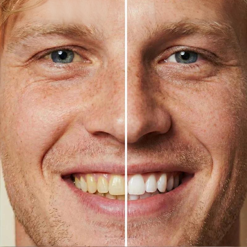 🦷Vernice sbiancante istantanea per denti da 5 ml – Effetto rapido, sicura per lo smalto e facile da applicare 💎